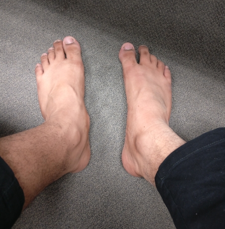 부주상골 증후군 치료에서 운동, 깔창, 보험처리까지 한방에 정리