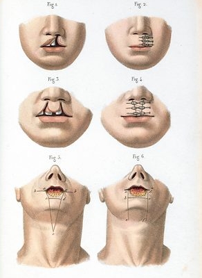 언청이 뜻, 원인부터 유전, 수술까지