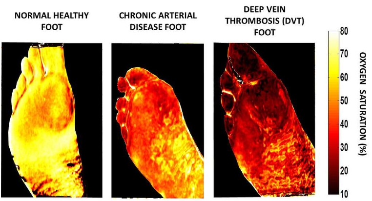 어린이와 성인을 위한 심부정맥 혈전증 증상 설명