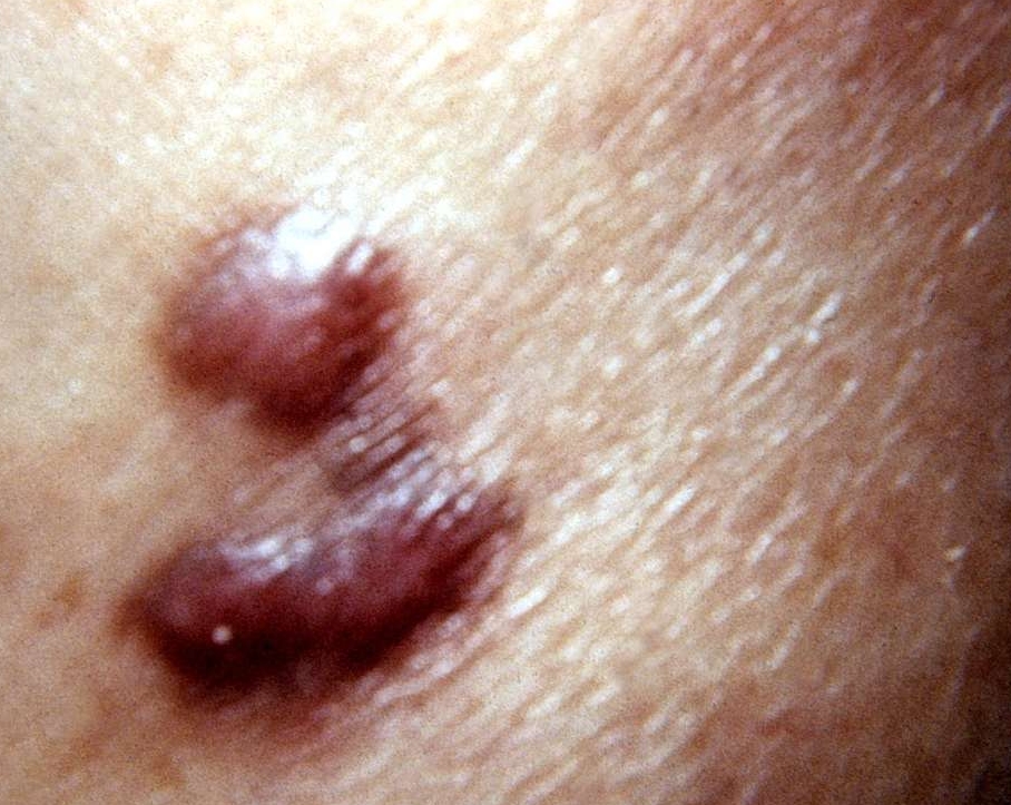 육종 암 말기 증상