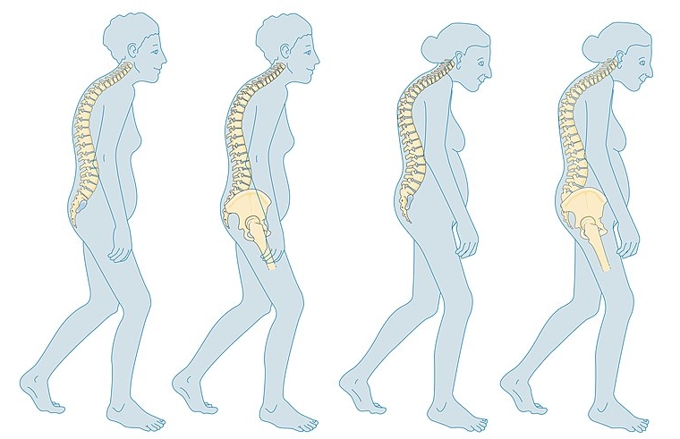 폐경이 신체에 미치는 영향