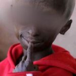 소아조로증 원인, 수명 및 치료 등 급속 노화 장애