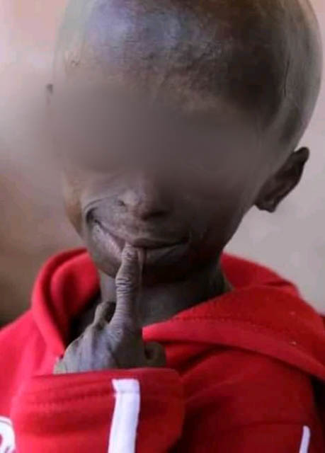 소아조로증 원인, 수명 및 치료 등 급속 노화 장애