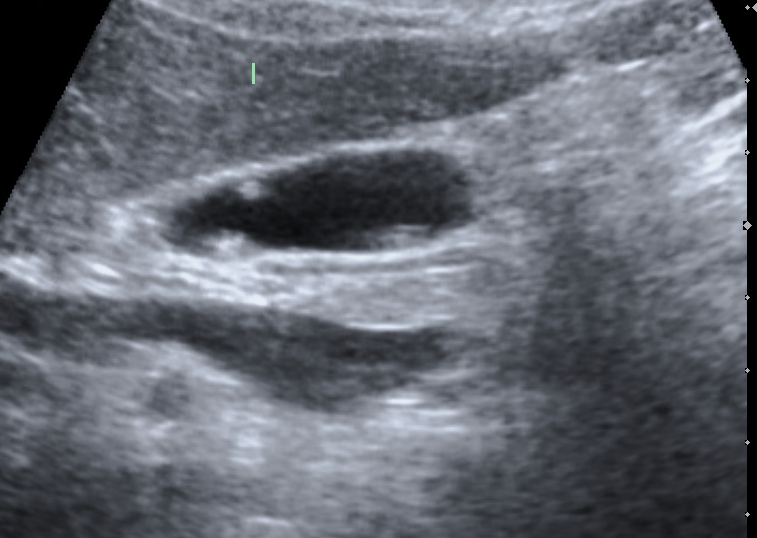 담낭 용종 진단하기
