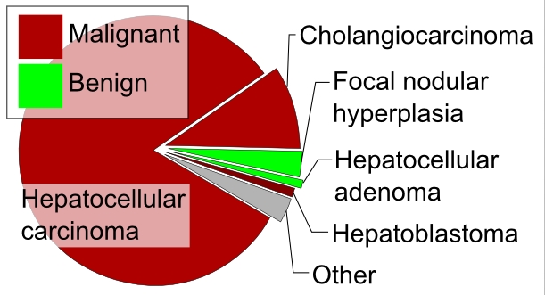 간암 초기증상 에서부터 원인, 진단 및 치료까지 정리