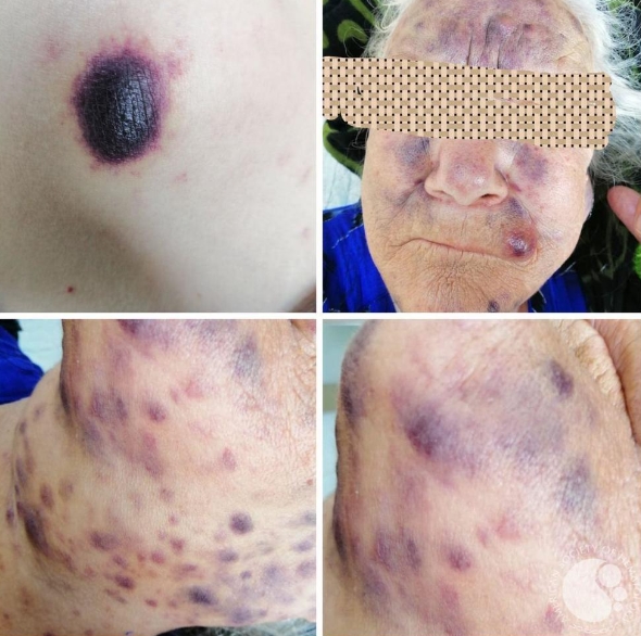 급성 백혈병 이해: 원인, 증상, 진단, 완치율 해독하기