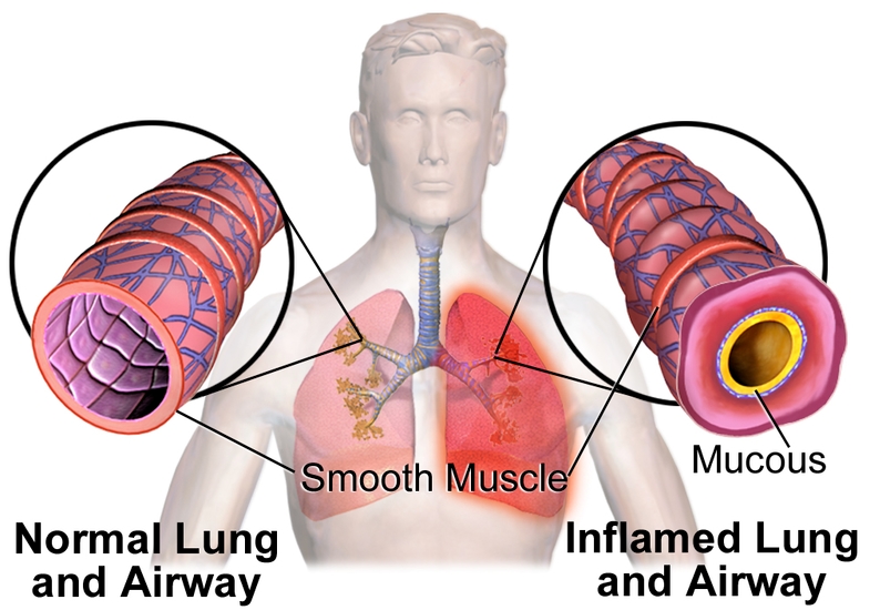 만성 폐쇄성 폐질환 천식 관리하기:원인, 증상 및 대처하기