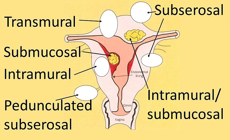 장막하근종 살펴보기: 증상, 원인 및 치료방안 확인하기