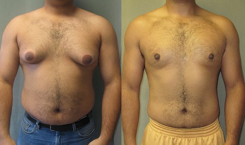 여유증 2b의 진실: 원인, 증상 및 치료 옵션 한번에 확인하기