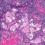 임파선 염(림프절염) 증상, 원인, 전염, 치료 및 좋은 음식