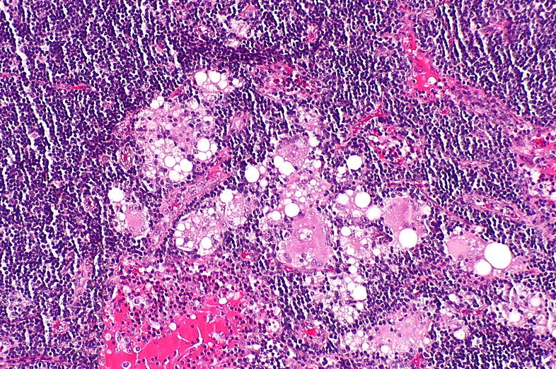 임파선 염(림프절염) 증상, 원인, 전염, 치료 및 좋은 음식