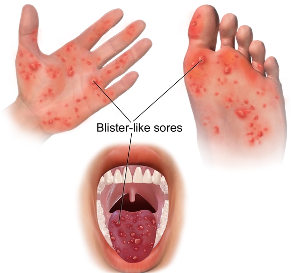 수족구 병 초기 증상, 어른 전염, 예방 및 치료 정리