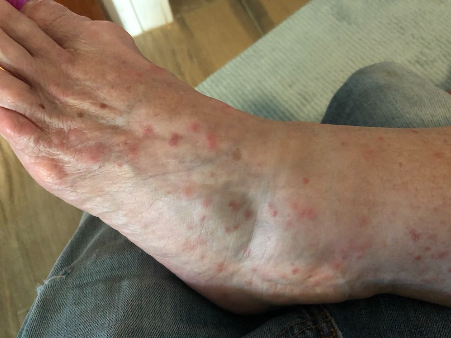 어른(성인)의 수족구