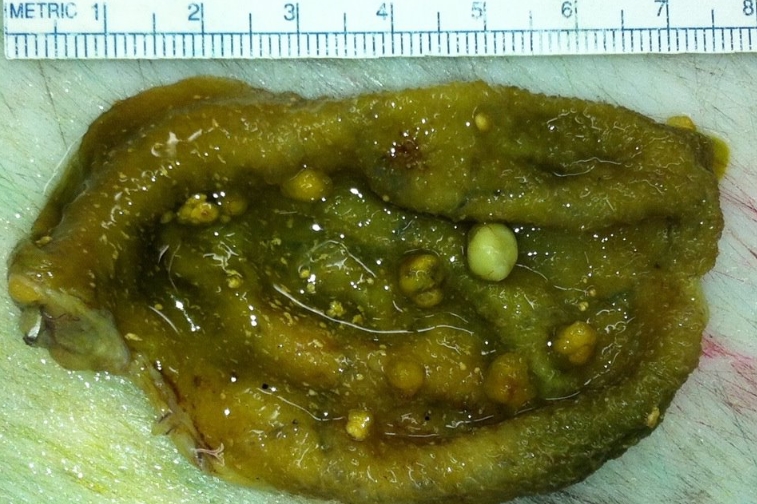 담낭 용종 증상