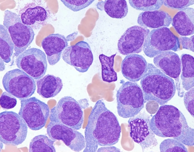 급성 백혈병 진단