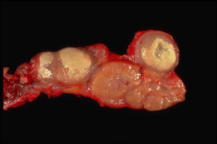 임파선 염의 증상