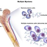 골수암에 대한 이해: 증상, 원인, 치료법 및 완치, 혈액암과의 차이점