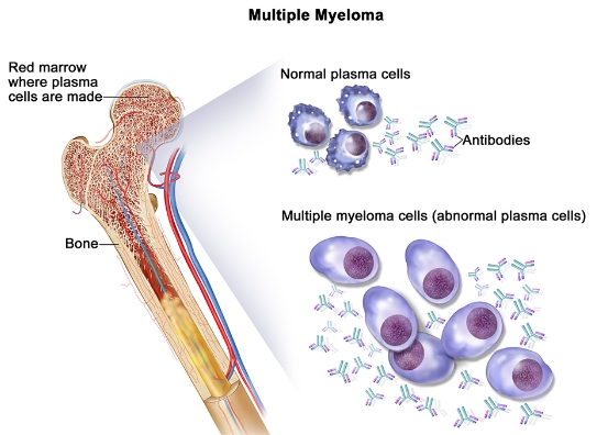 골수암에 대한 이해: 증상, 원인, 치료법 및 완치, 혈액암과의 차이점