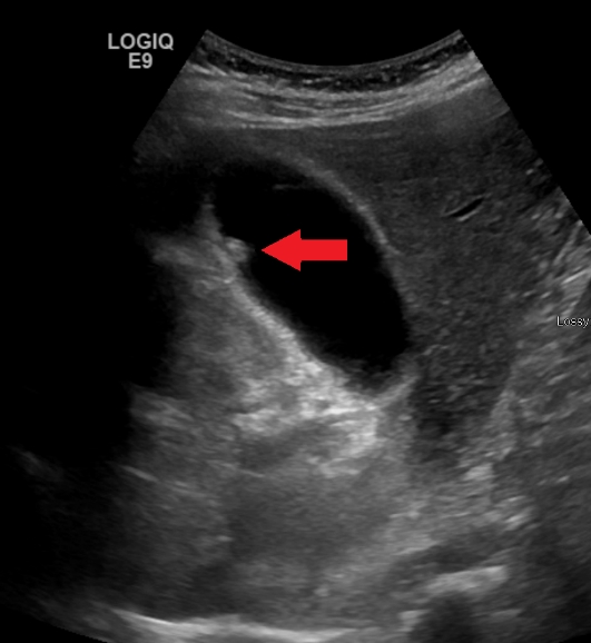 담낭 용종 원인부터 증상, 자연치유, 커피, 진단 및 치료까지