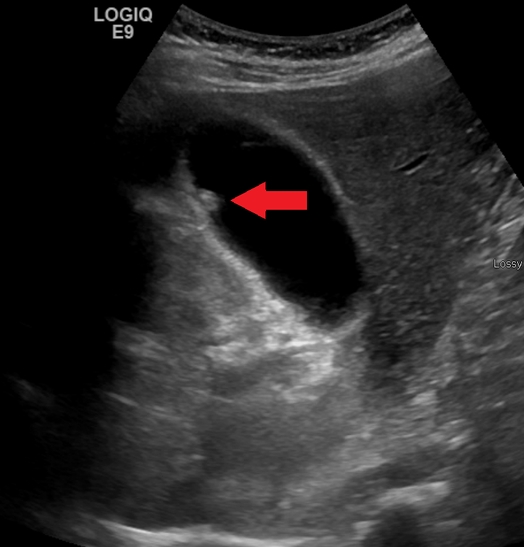 담낭 용종의 증상에서 원인, 크기, 관리, 수술 및 예방까지 한방에 정리