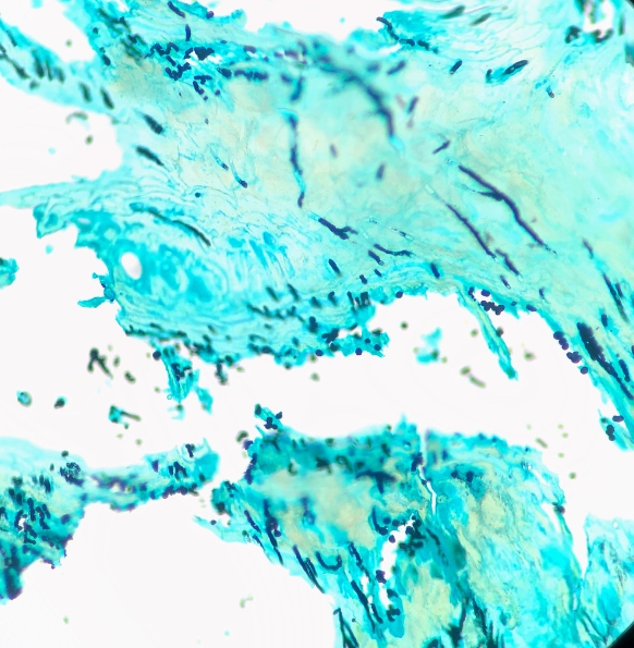 조갑사상균증-치료를 받는 것의 중요성