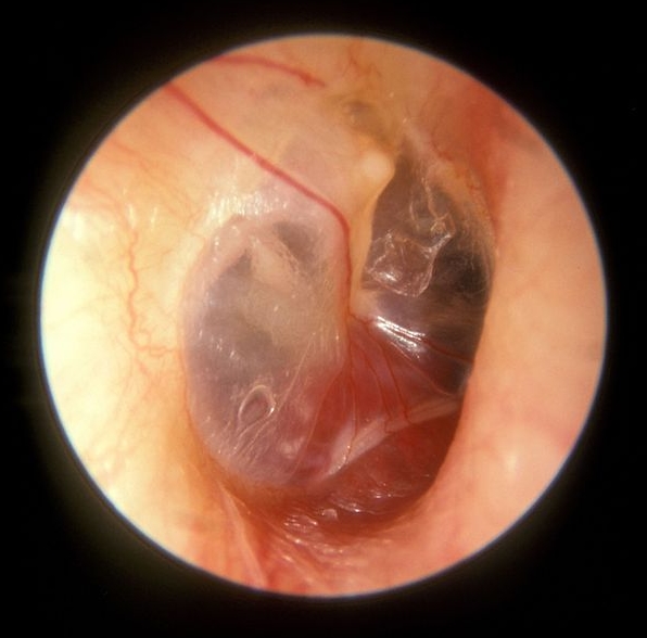 혈관 종양: 종류, 원인 및 효과적인 치료법 살펴보기