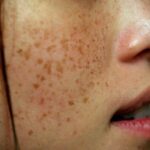 주근깨와 잡티: 원인, 제거 및 레이저에 대한 가이드