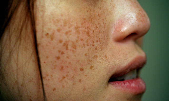 주근깨와 잡티: 원인, 제거 및 레이저에 대한 가이드