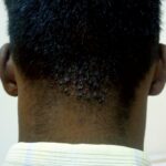 모낭염 탈모 이해하기: 원인에서부터 증상 및 치료법까지 한방에 정리