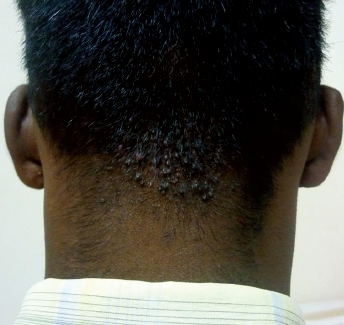 모낭염 탈모 이해하기: 원인에서부터 증상 및 치료법까지 한방에 정리