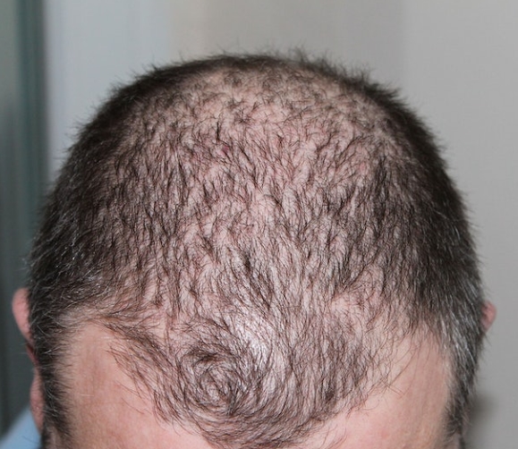 모낭염 탈모 이해하기: 원인에서부터 증상 및 치료법