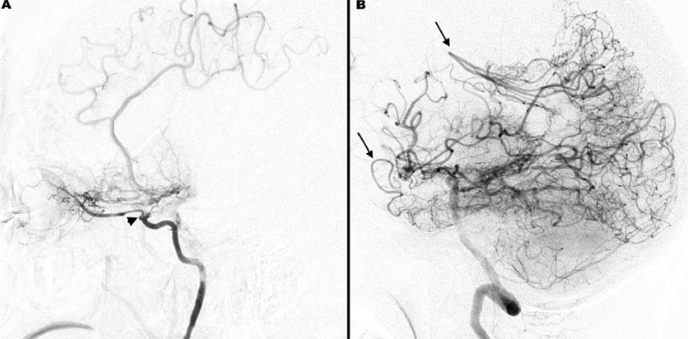 모야모야병 유전적 요인