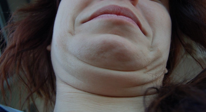 턱살빼는법에 대하여