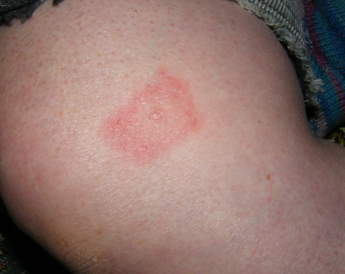 라임병의 원인은 무엇인가요?박테리아 감염