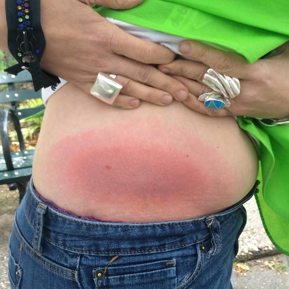 라임병에 대한 최신 정보를 확인하세요: 증상, 원인, 그리고 안전을 지키는 예방