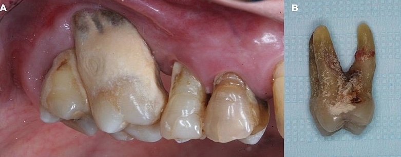 잇몸 병 치료 방법: 효과적인 가정 요법 및 예방
