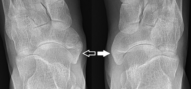 부주상골증후군에 대한 이해: 원인, 증상, 징후, 진단 및 치료 방법