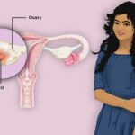 난소 낭종 파열에 대한 종합 가이드: 원인, 증상, 출혈, 종류 및 치료의 이해