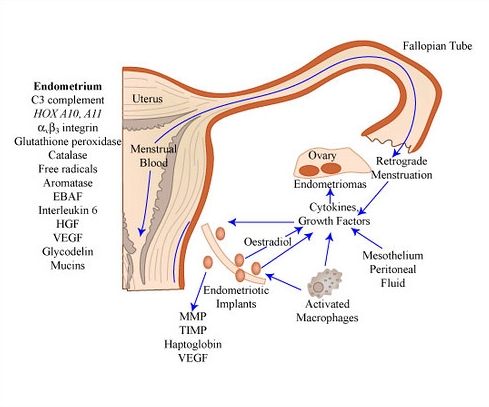 자궁내막증 검사에 대한 오해와 진실: 진단으로 가는 길