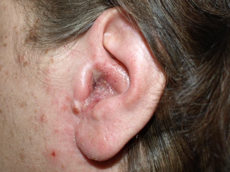 귀 염증 원인 및 증상부터 치료, 턱과 두통의 연관성, 항생제 까지 요약 정리