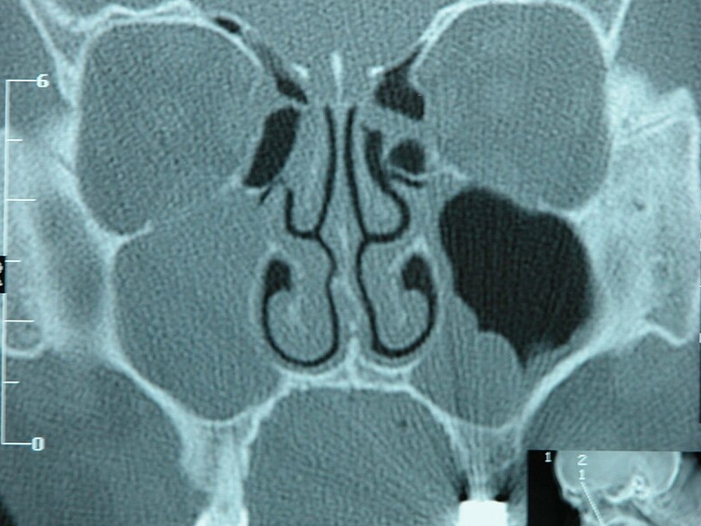 점액 낭종 원인, 증상, 치료 및 예방, 좋은 음식, 손가락 낭종