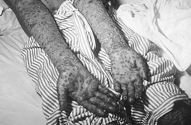 천연두 원인, 증상, 전염