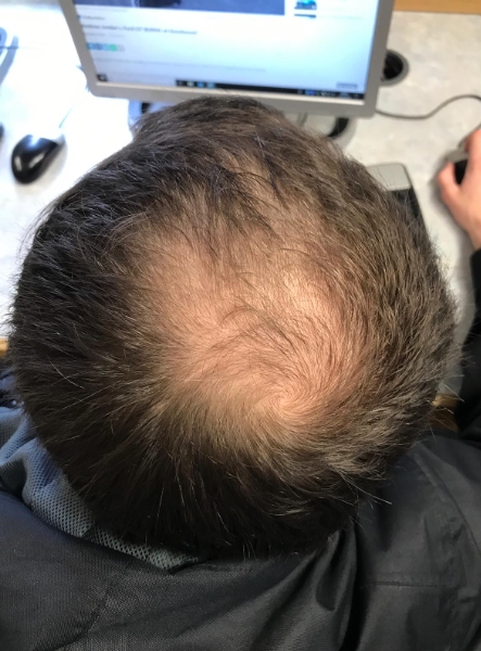 남자 정수리 탈모가 당신의 첫인상을 결정하지 못하게 하세요!