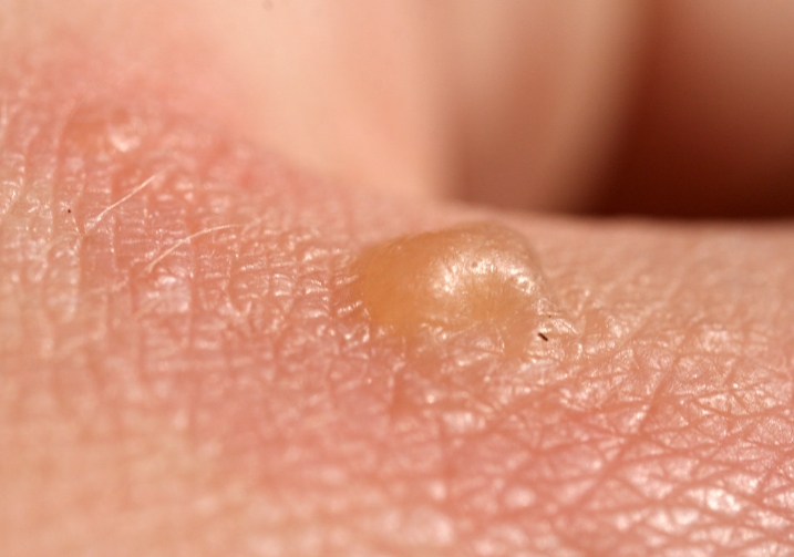 쥐젖 이해하기: 원인, 제거 방법 및 제거하지 말아야 할 때