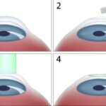 원시 라식으로 더 나은 눈 건강을 향해