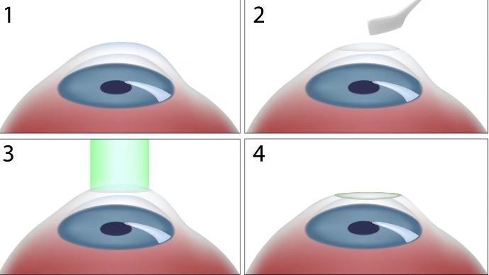 원시 라식으로 더 나은 눈 건강을 향해