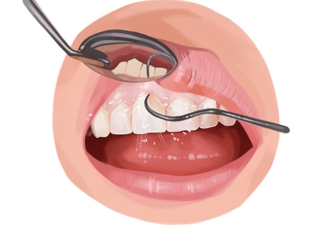 미소와 저축: 잇몸 치료 보험 최대한 활용하기