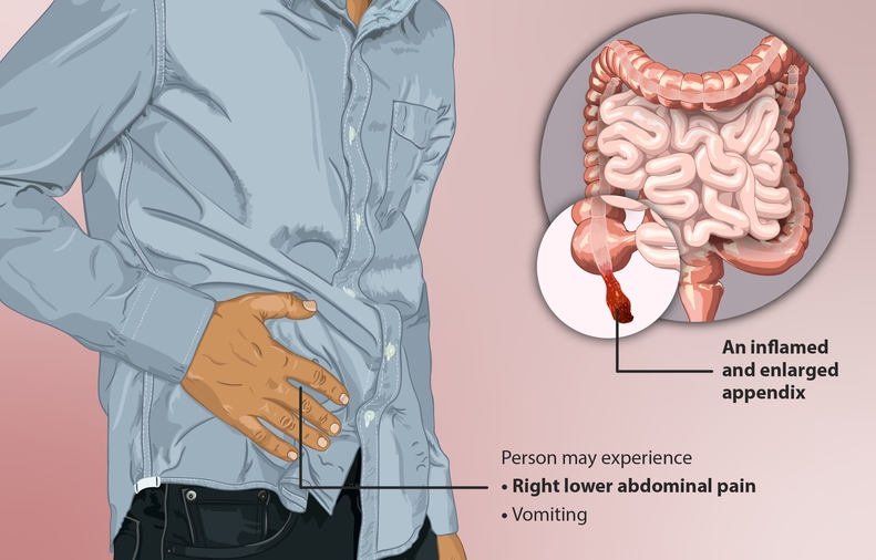맹장위치(남자,여자), 통증, 충수염 및 맹장염, 자가진단 요약정리