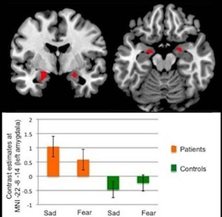 결여발작의 원인